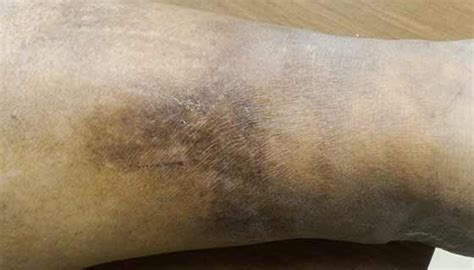 Cellulitis | Johns Hopkins Medicine