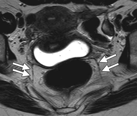 Mri uterus radiographics – Ecopet