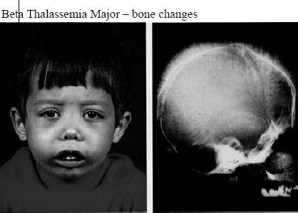 Haemoglobinopathies - clinical Presentation, molecular basis | Barts Wiki | FANDOM powered by Wikia