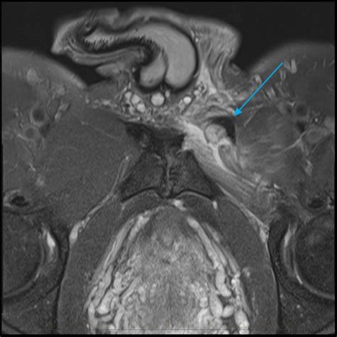 melbourne-mri-groin-09-arrow - MRI at Melbourne Radiology Clinic