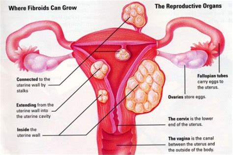 Menorrhagia Causes, Symptoms, Diagnosis and Treatment - Natural Health News