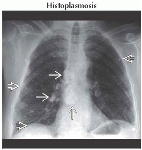 High-Attenuation Mass, Mediastinum or Hilum | Thoracic Key