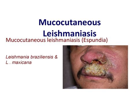 Leishmaniasis. Department of Infectious Diseases Leishmaniasis - online presentation