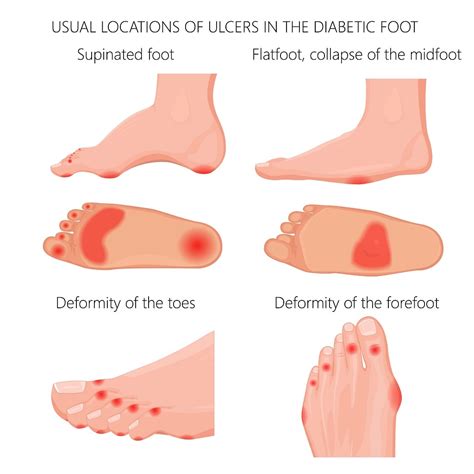 Diabetic Charcot Foot: Symptoms, Diagnosis and Treatments