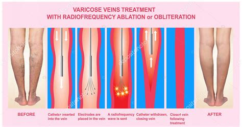 Varicose Veins and Treatment with radiofrequency ablation - UDAI OMNI ...