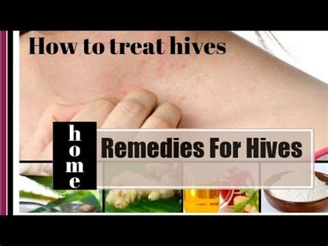 How to treat hives | home remedy for hives - YouTube