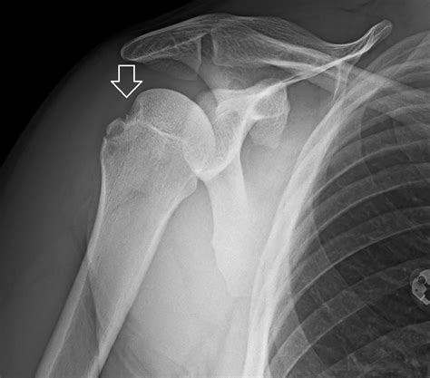 X Ray Shoulder Dislocation