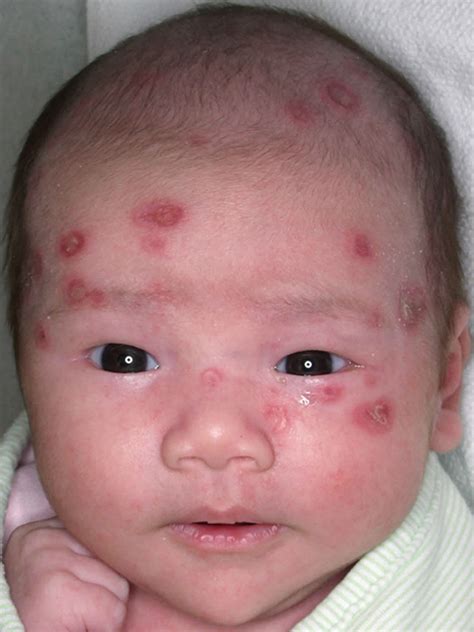 Pediatric lupus causes, symptoms, diagnosis, treatment & prognosis