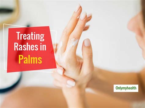 Experiencing Palm Rashes? Here's Are Some Treatment Tips From ...