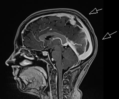 Intracranial Hypotension with Dural Sinus Thrombosis