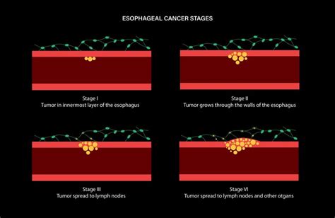 Premium Vector | Esophageal cancer stages