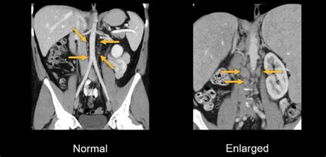 Abdominal CT: lymph nodes • LITFL • Radiology Library