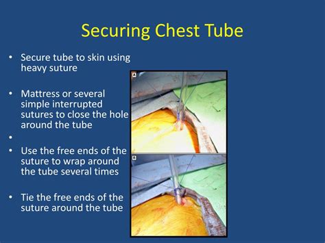 Chest Tube Incision