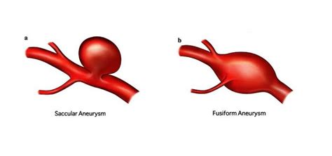 Aneurysm – Dentowesome