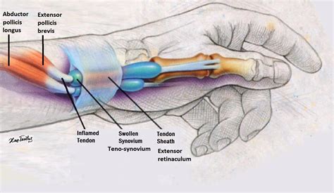 Abductor Pollicis Longus Tendon | My XXX Hot Girl