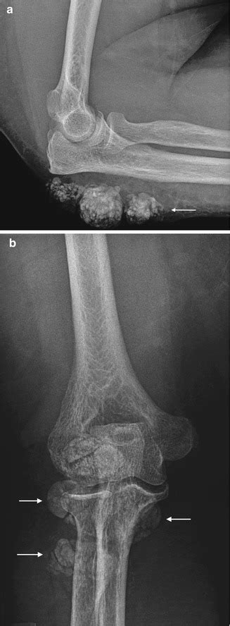 Soft Tissue Calcifications | Radiology Key