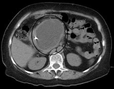 Pancreatic pseudocyst - Wikipedia, the free encyclopedia