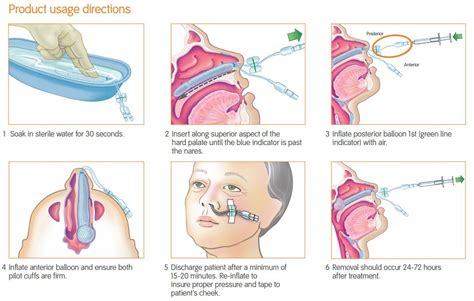 Rapid Rhino Epistaxis balloon catheter 7.5 cm - Medische Vakhandel