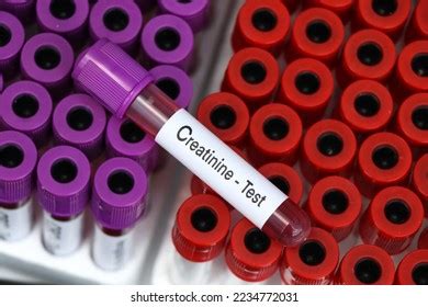 Creatinine Test Look Abnormalities Blood Blood Stock Photo 2234772031 ...