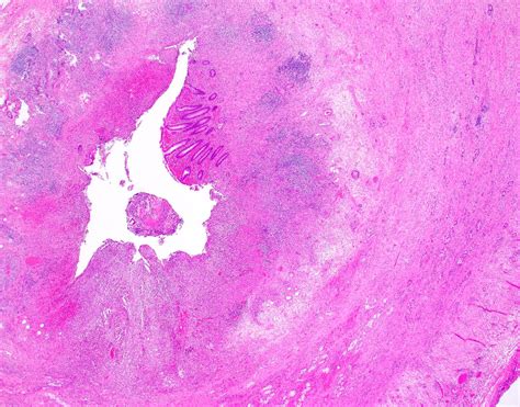 Pathology Outlines - Goblet cell adenocarcinoma