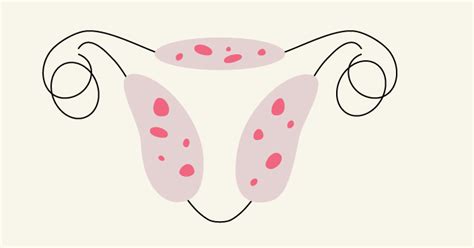 Adenomyosis and Pregnancy: Can Adenomyosis Cause Pregnancy Complications?