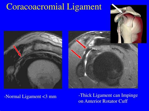 Coracoacromial Ligament Mri