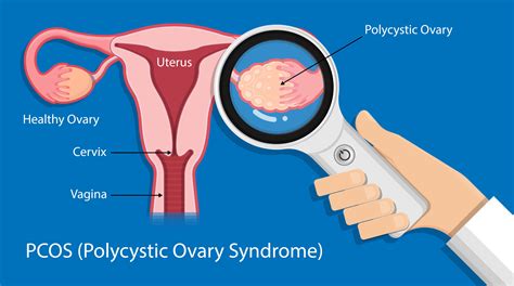 pcos-pic - Higher Health Naturopathic Centre and IV Lounge