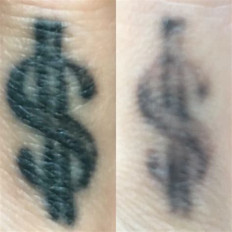 Removal of Tattoo With Keloid Scarring : TattooRemoval