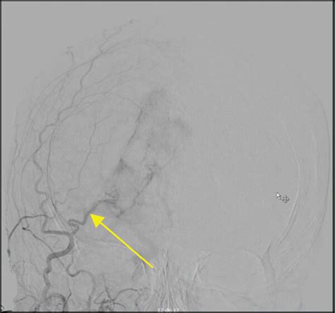 (a and b) Pre-operative carotid angiogram revealing the occlusion of... | Download Scientific ...