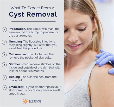 what to expect from cyst removal | Epiphany Dermatology