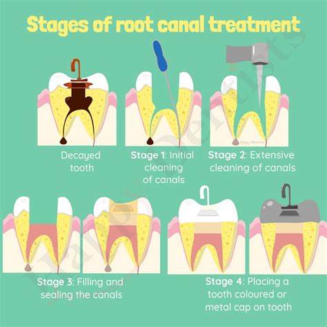 Root Canal Treatment | Happy Dentists