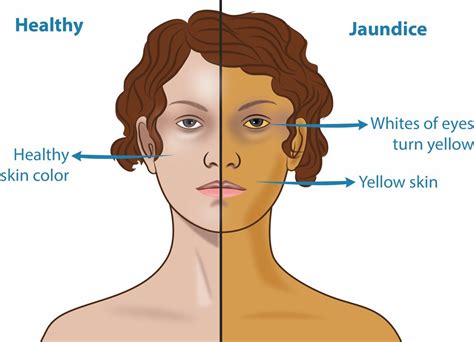 Jaundice Perth | Symptoms & Treatments - Liver Specialists & Surgeons