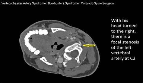 Vertebrobasilar Artery Syndrome | Vertebrobasilar Artery Ischemia ...