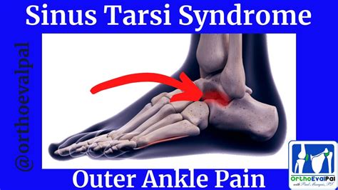 Sinus Tarsi Syndrome (Outer Ankle Pain) - YouTube