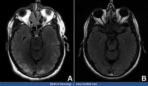 Hypertensive encephalopathy | MedLink Neurology