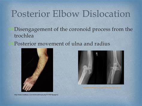 Improving Orthopedic Elbow Reduction Techniques through Clinical Simu…