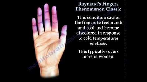 Raynaud's Fingers Phenomenon classic - Everything You Need To Know - Dr ...