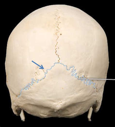 Lambdoid Suture