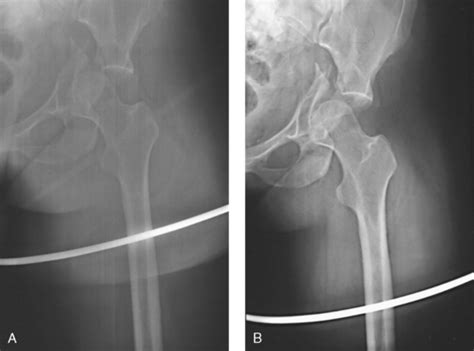 MOBILE RADIOGRAPHY | Radiology Key