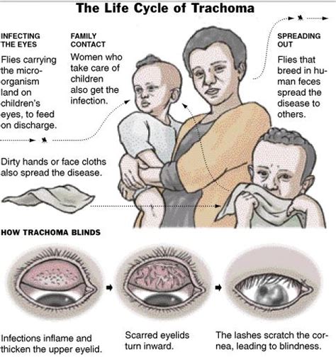 Trachoma – Definition, Symptoms, Treatment, Pictures, Causes