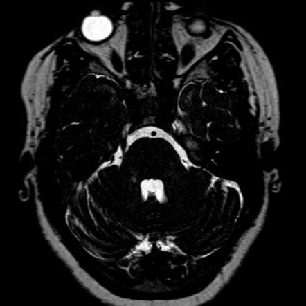 5th Cranial Nerve Mri