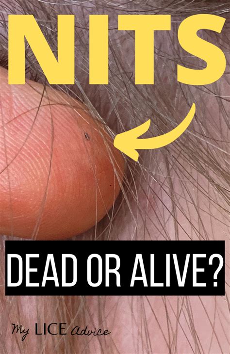 Dead vs Live Nits: Color of Lice Eggs in 2020 | Lice eggs, Louse