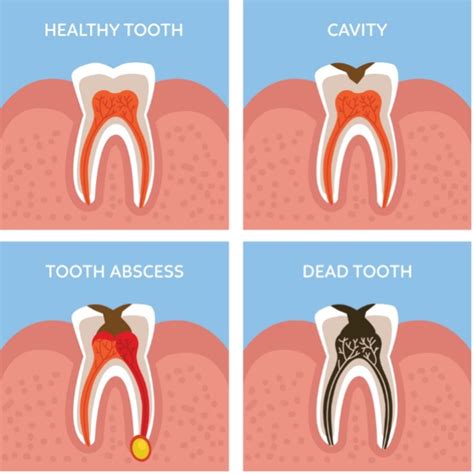 Do I Need a Root Canal if There is No Pain? - Modern Care Endodontics