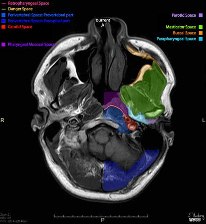 Parapharyngeal space | Radiology Reference Article | Radiopaedia.org