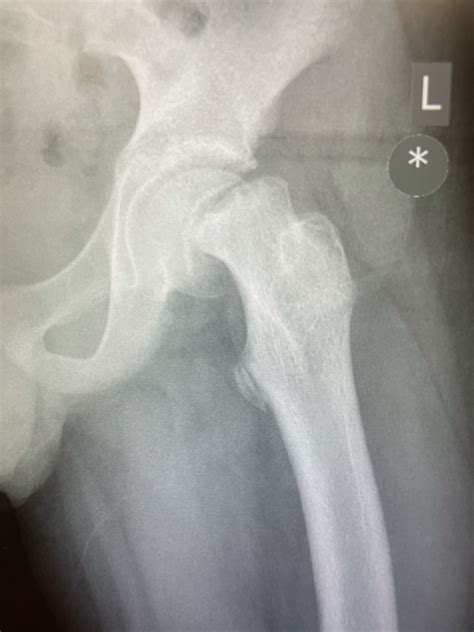 Slipped capital femoral epiphysis (SCFE) - Resource Library - Sheffield ...