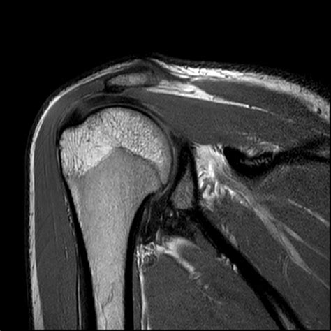 Shoulder Mri Without Contrast