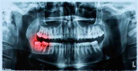 Impacted Teeth Removal | Tennessee Valley Oral Surgery