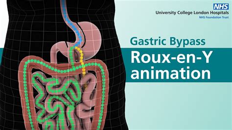 Gastric Bypass | Roux-en-Y animation - YouTube