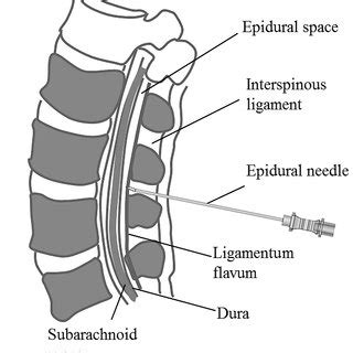 Graphical representation of the epidural space and surrounding anatomy... | Download Scientific ...