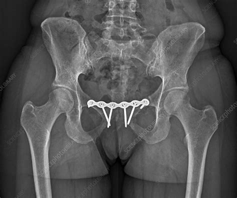 Pinned broken pelvis, X-ray - Stock Image C001/7403 - Science Photo Library